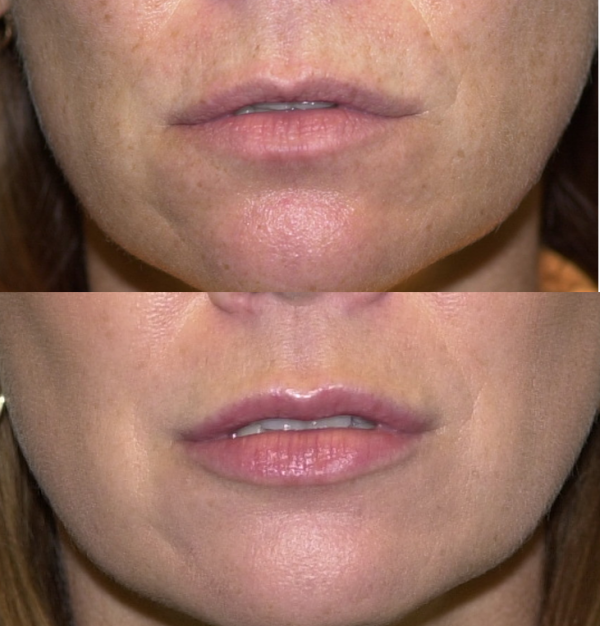 Dermal Fillers & Lip Injections Richmond VA Juvederm Volbella & More