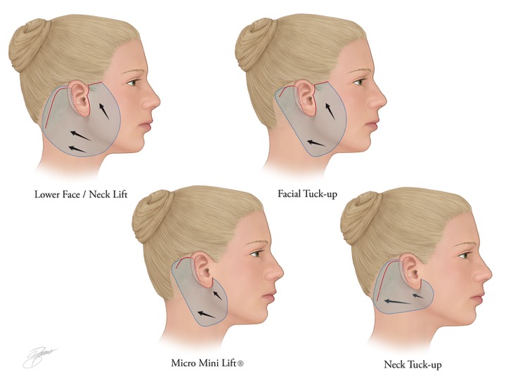 different facelift types