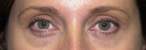blepharoplasty richmond va before and after
