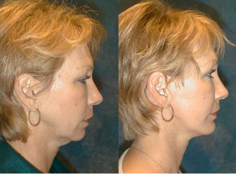 facelift richmond before and after