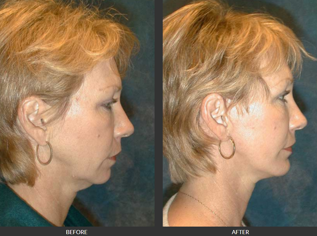 top rated facial plastic surgeon richmond virginia before and after